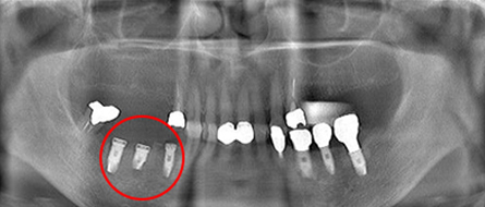 仮歯・インプラントが取れた方の症例